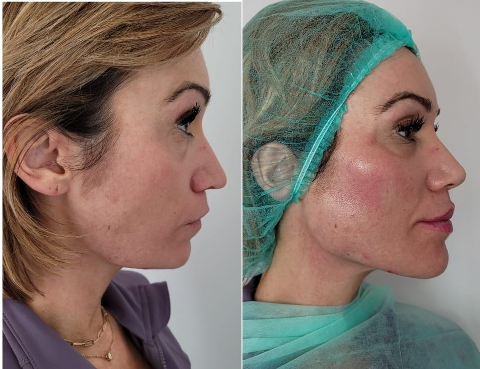 Jaw-line and chin contouring