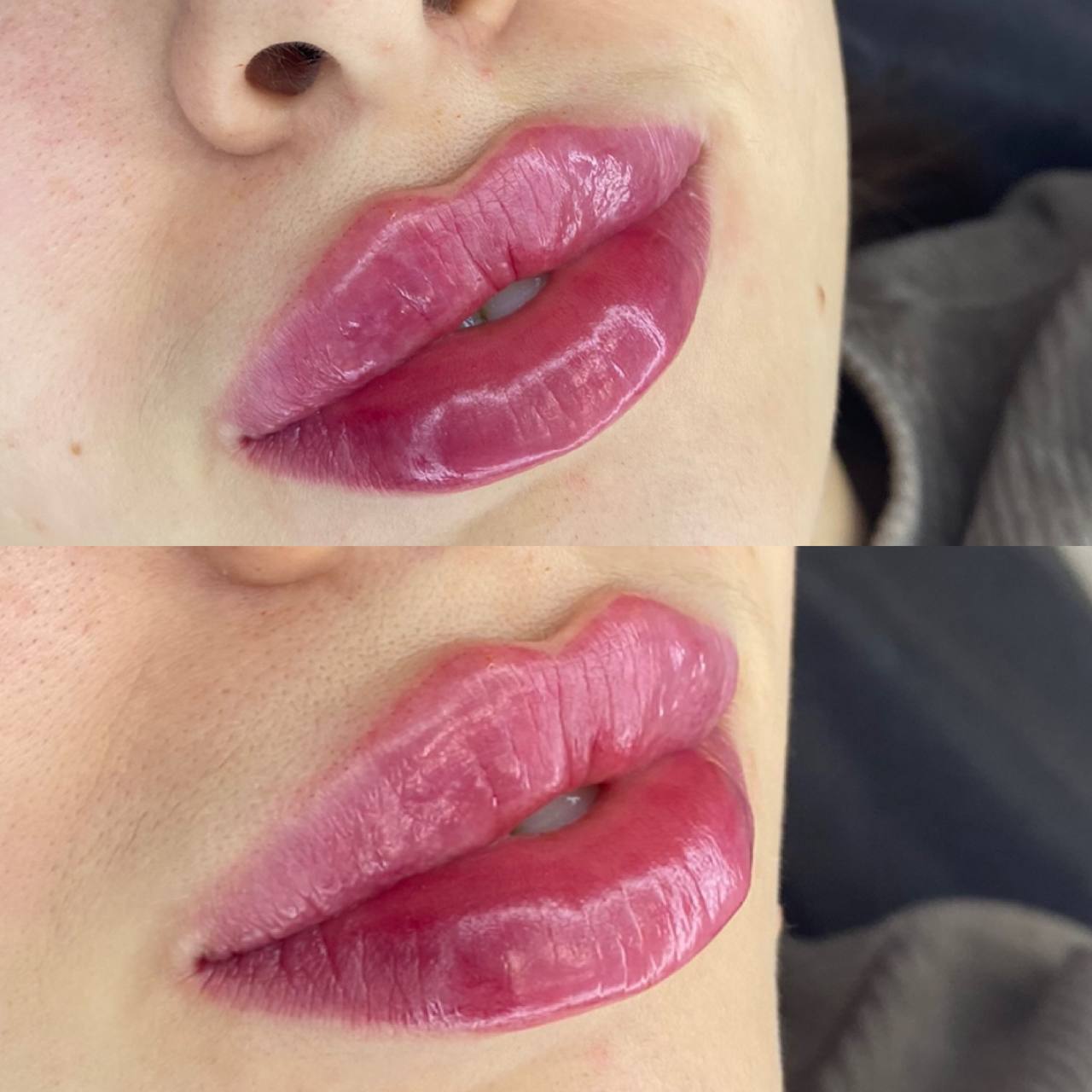 lip augmentation