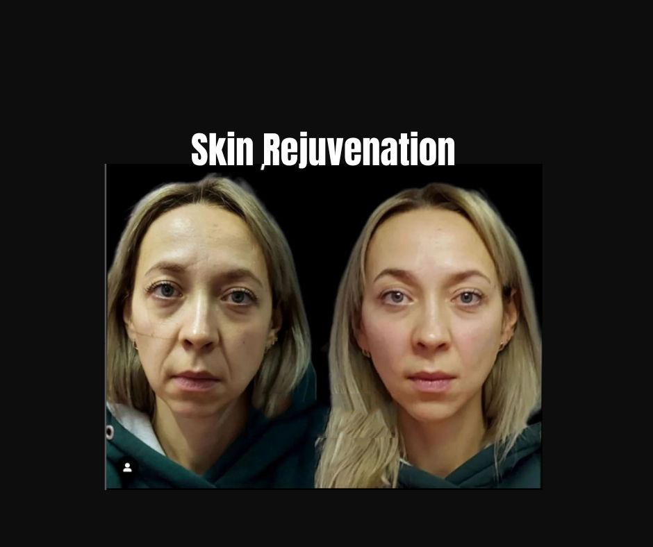 Skin-Rejuvenation-1