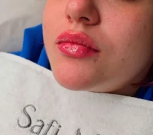 Swelling After Lip Augmentation Immediately Following Injections
