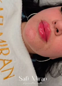 Lip Filler Swelling Immediately After the Procedure