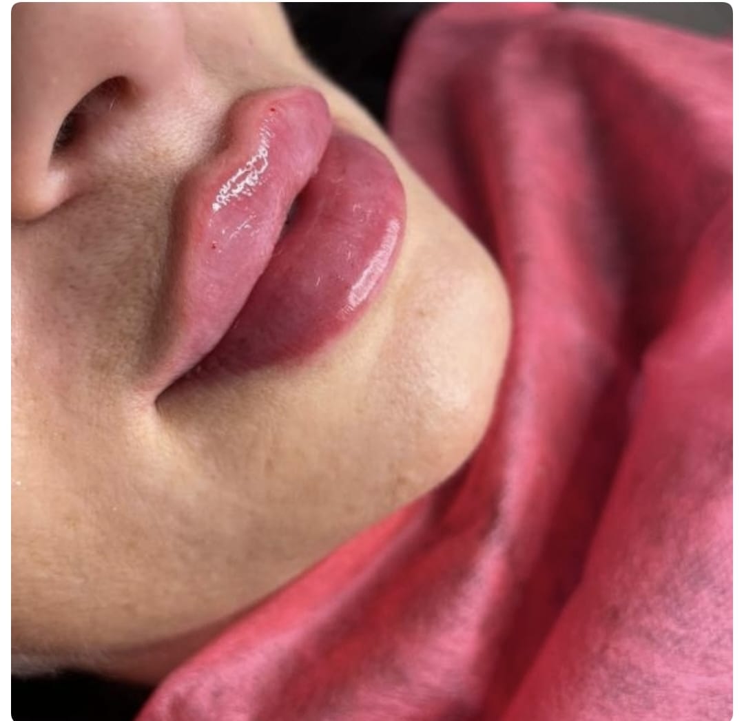 Lip filler