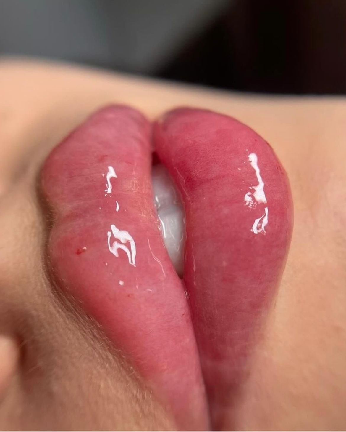 Lip filler