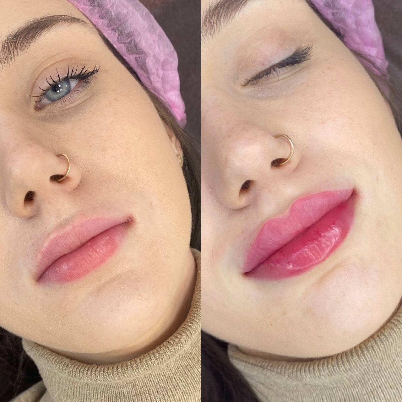 Lip filler before and after