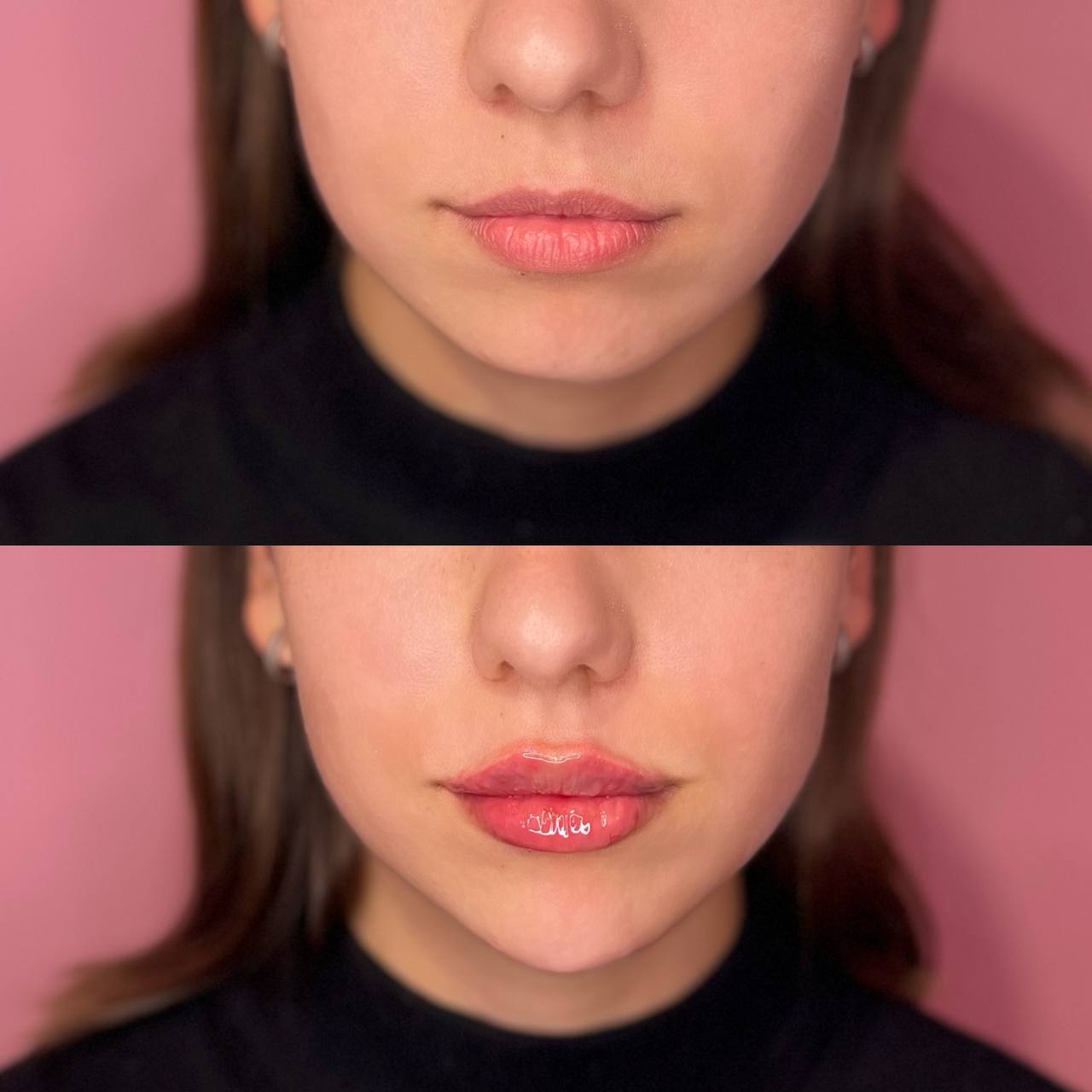 Lip filler before and after