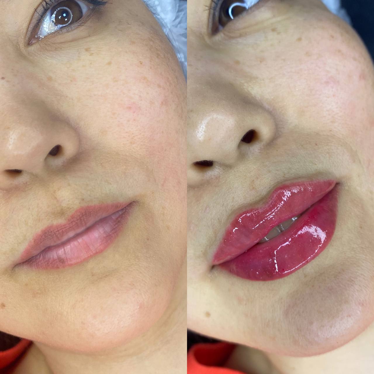 Lip filler before and after