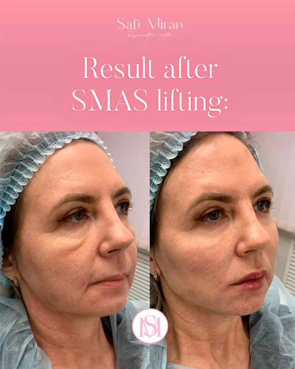 Malar bags treatment before and after