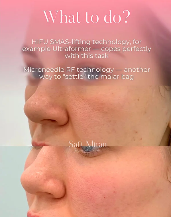 Malar bags treatment in Denver, CO