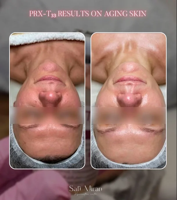 PRX-T33 Before and after