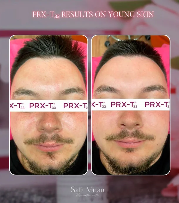 PRX-T33 Before and after