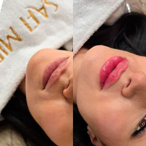 Best lip filler before and after