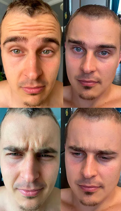 Botox for men before and after