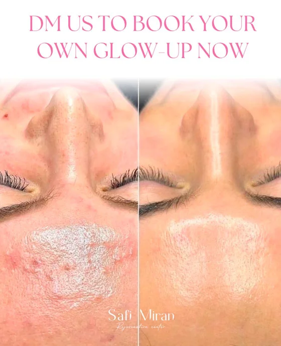 Chemical peel before and after