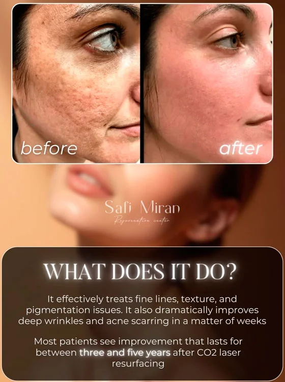 CO2 laser under eyes before and after