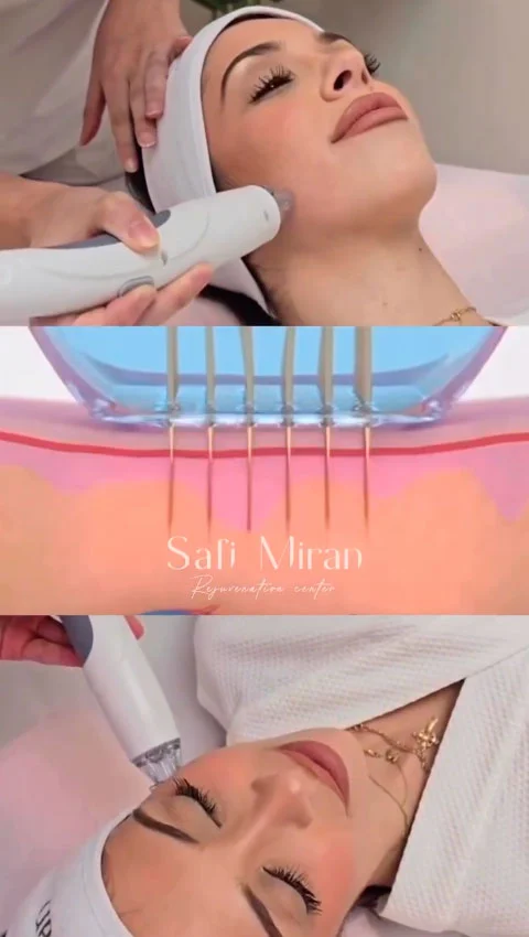 Microneedling in Denver, CO