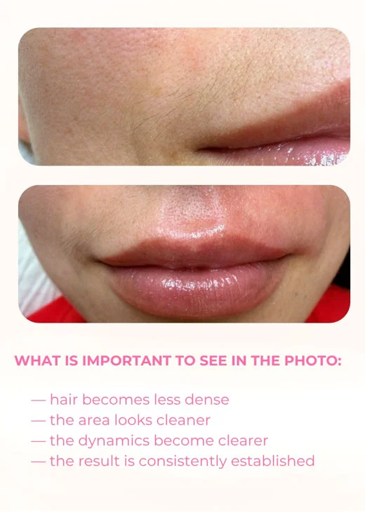 Laser facial hair removal before and after