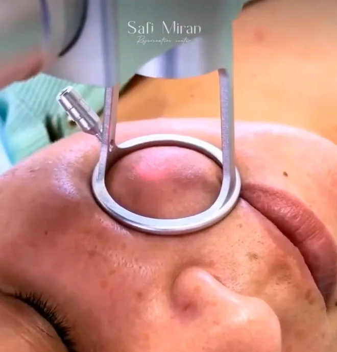 Laser treatment in Denver, CO