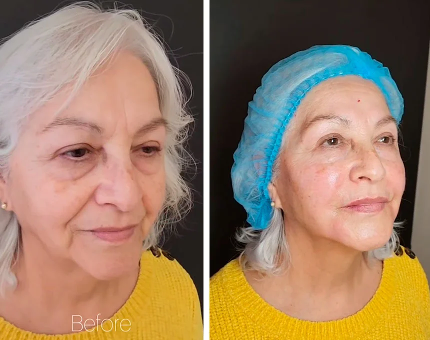 Under-eye bag treatment before and after