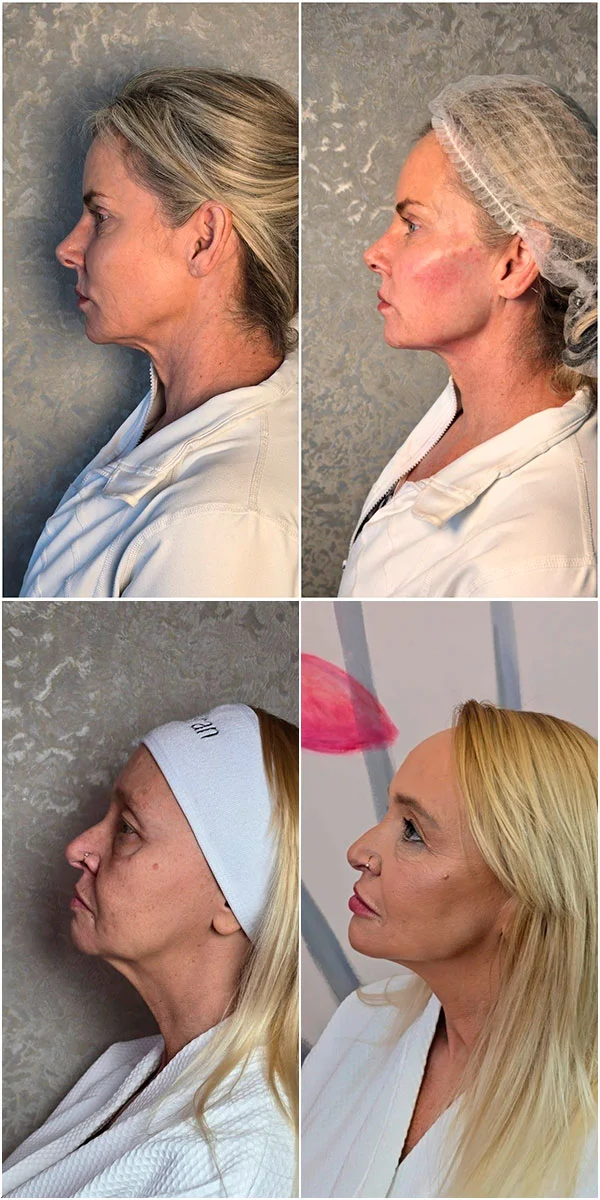Full-face Transformation before and after