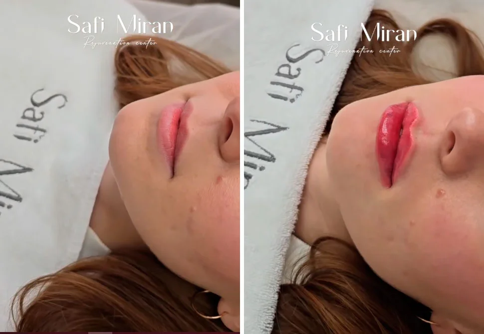 Lip filler before and after