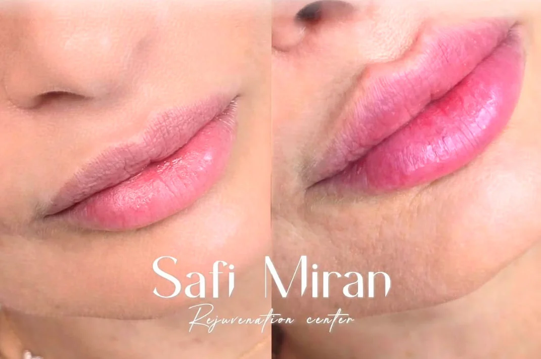 Lip augmentation before and after
