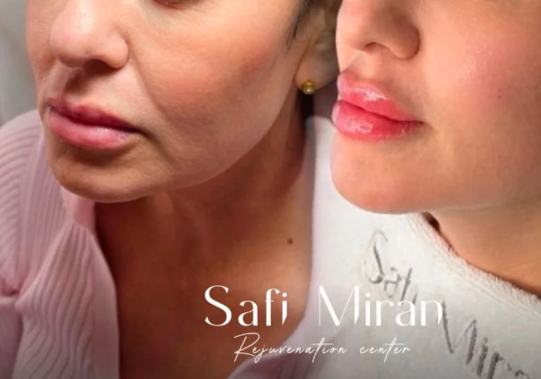 Lip contour enhancement before and after result