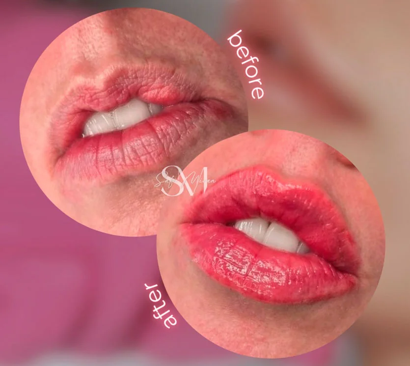 Lip filler before and after result at Safi Miran Denver