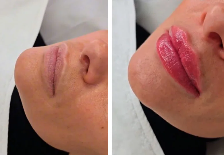 Lip definition before and after filler treatment