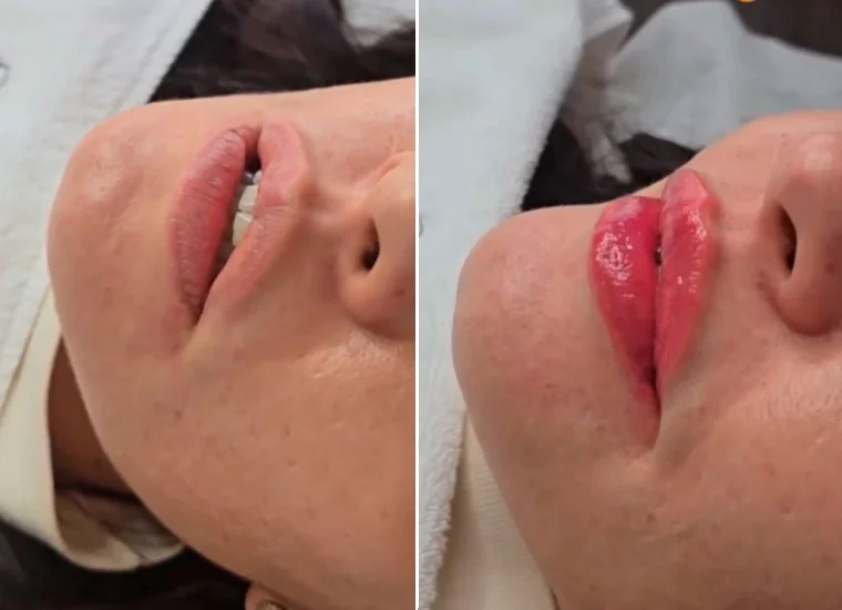 Lip volume enhancement before and after result