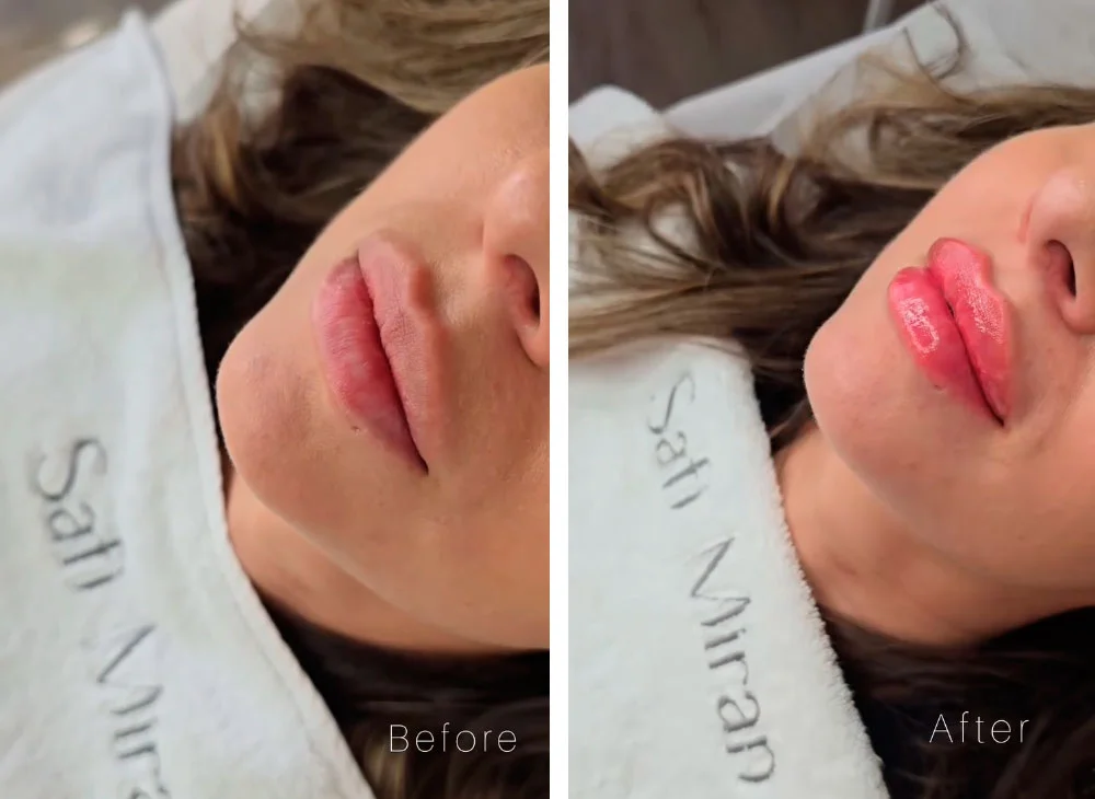 Lip filler before and after photos