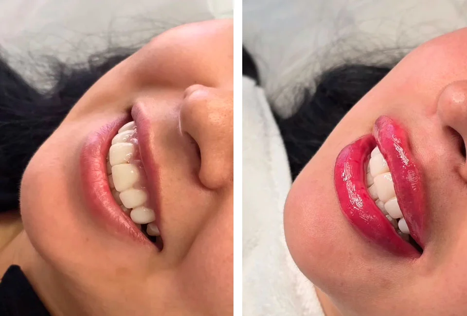 Natural lip enhancement before and after result
