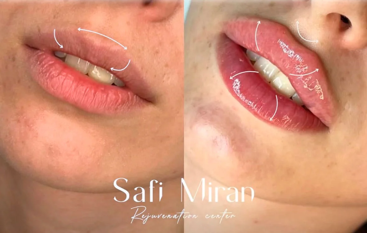 Lip filler before and after