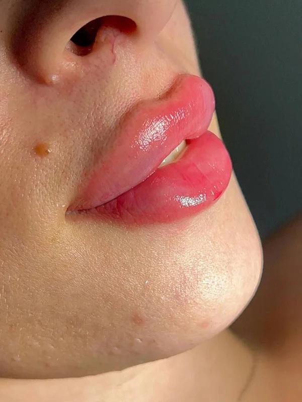 Russian lip filler result at Safi Miran Denver