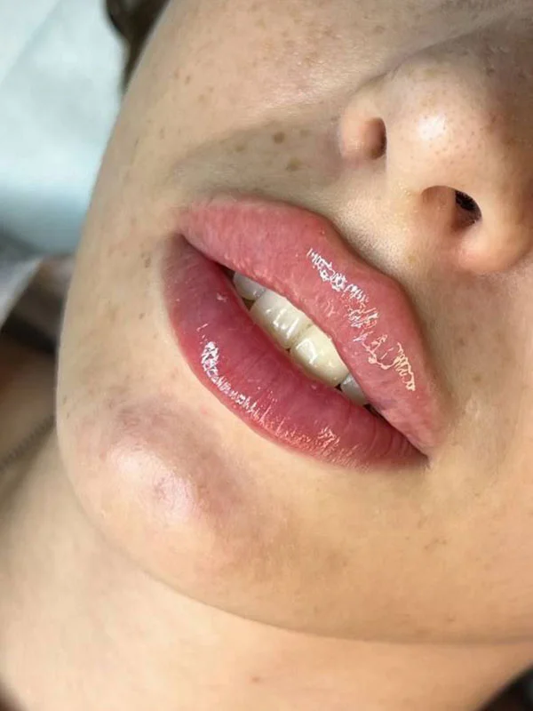Defined Cupid&rsquo;s bow after Russian lip filler