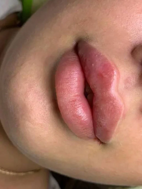 Russian lip technique result with enhanced definition