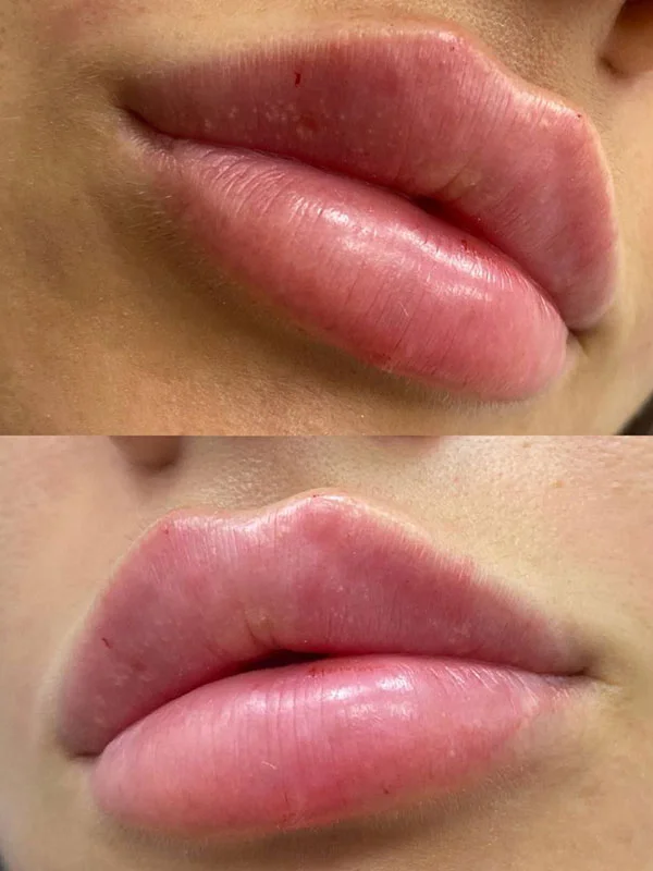 Natural-looking Russian lip filler result
