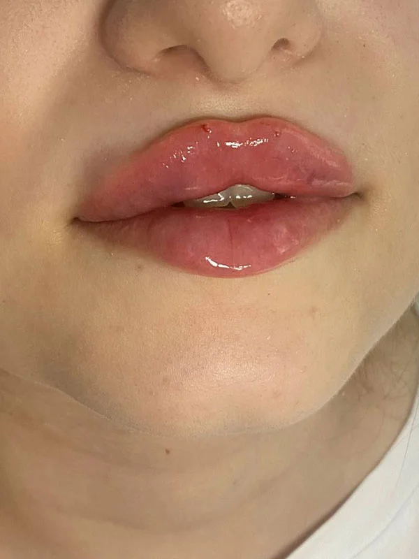 Russian lip filler result with balanced volume