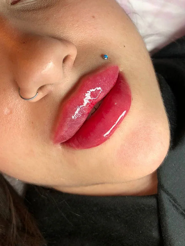Russian lip filler result with lifted lip shape