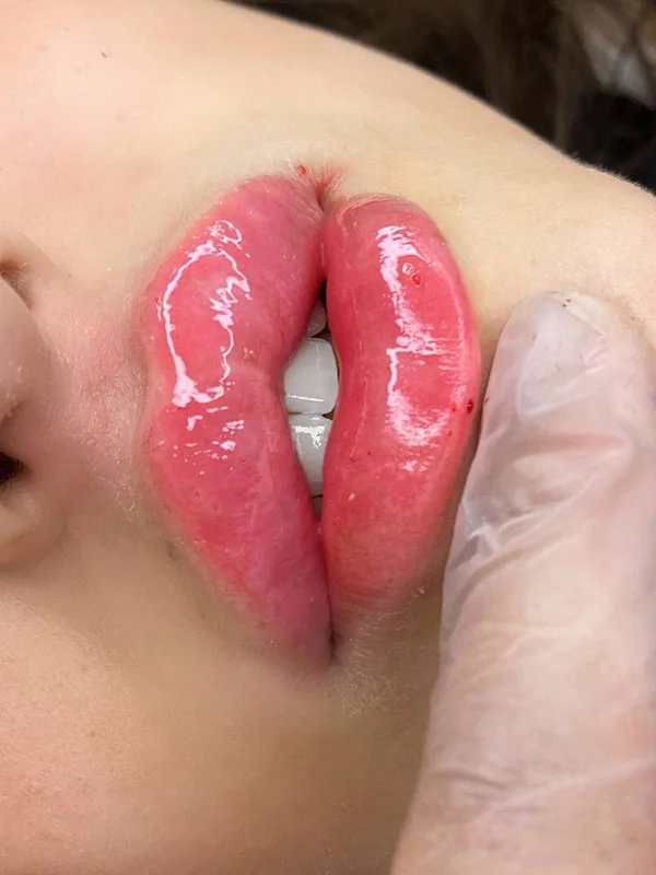 Russian lip enhancement result in Denver