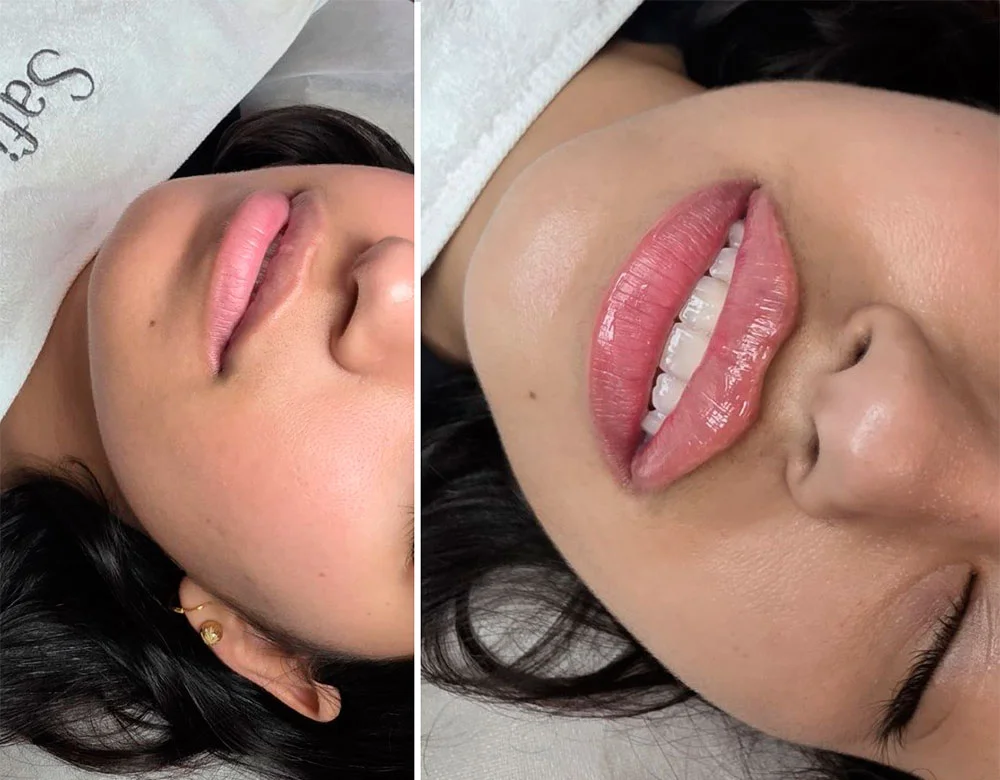Russian lip filler before and after