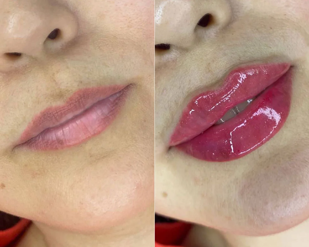Before and after Russian lip filler photos