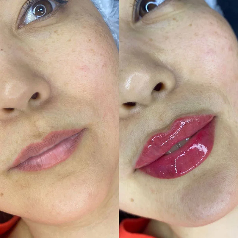 Russian lip filler before and after result at Safi Miran Denver