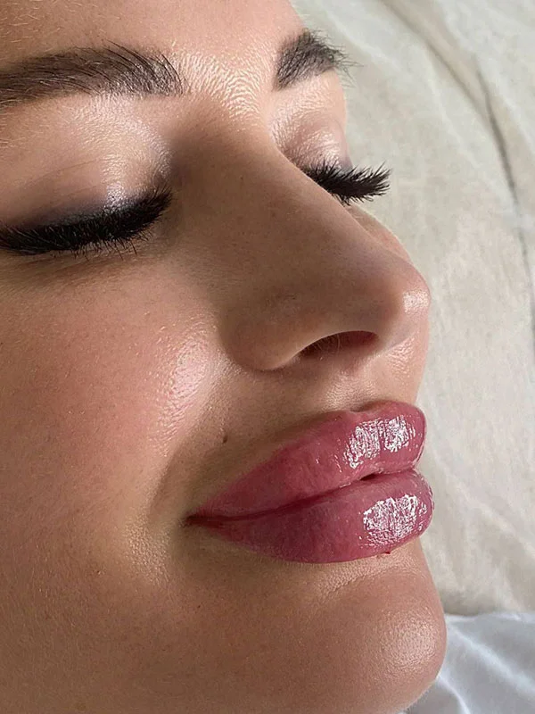 Russian lip filler result with defined lip shape