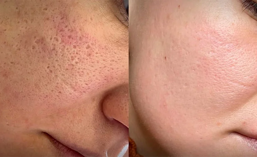 CO2 laser treatment result before and after