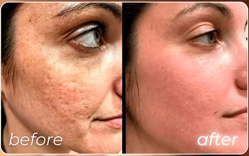Before and after fractional CO2 laser resurfacing