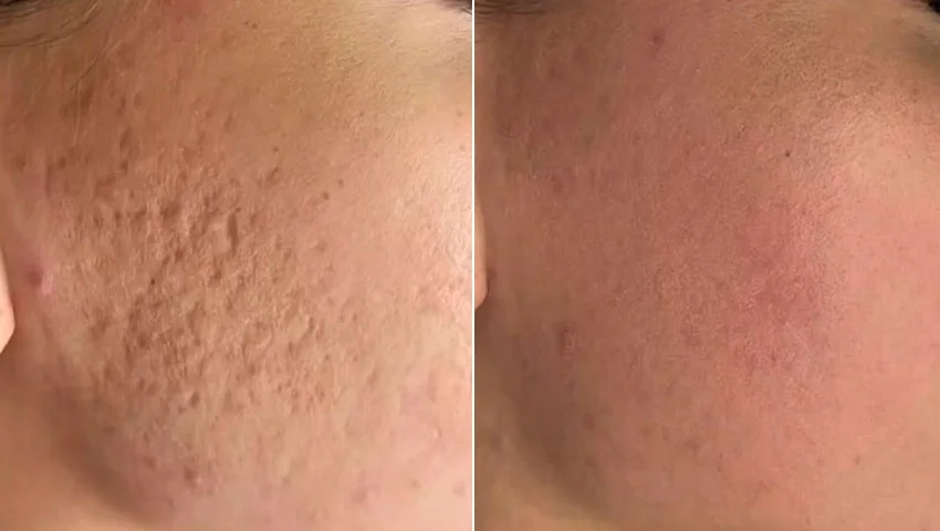 CO2 fractional laser before and after result