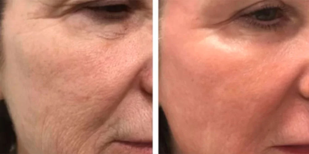 Skin appearance before and after CO2 laser treatment