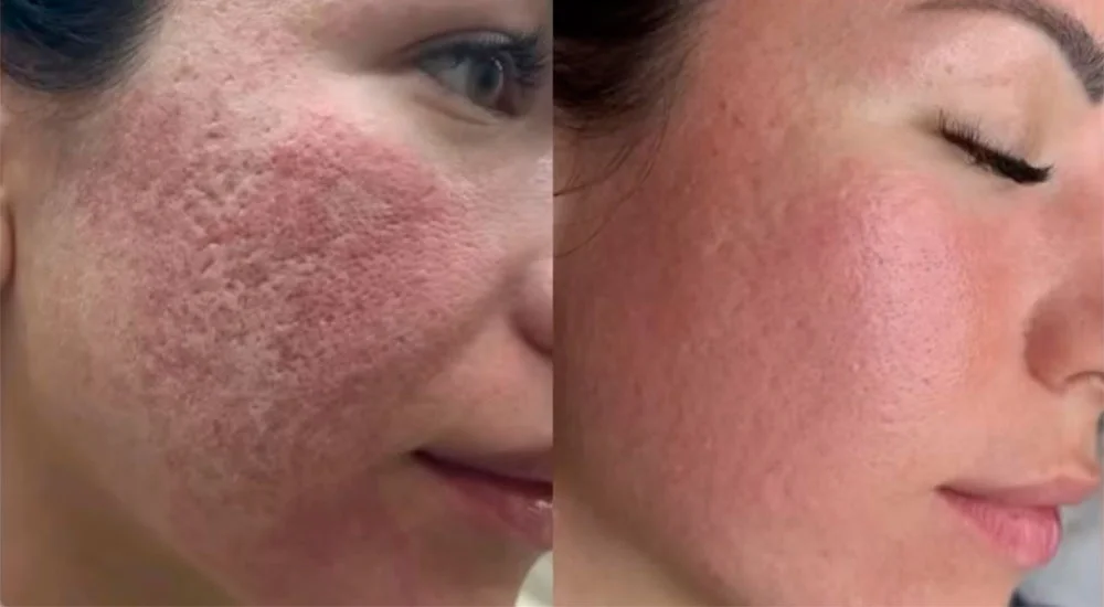 CO2 laser resurfacing before and after photo