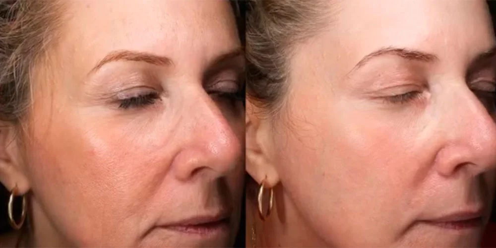 CO2 laser before and after