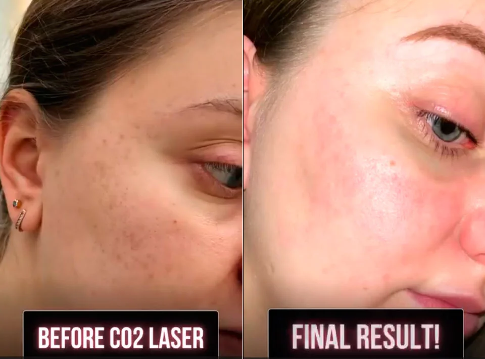 CO2 laser before and after result